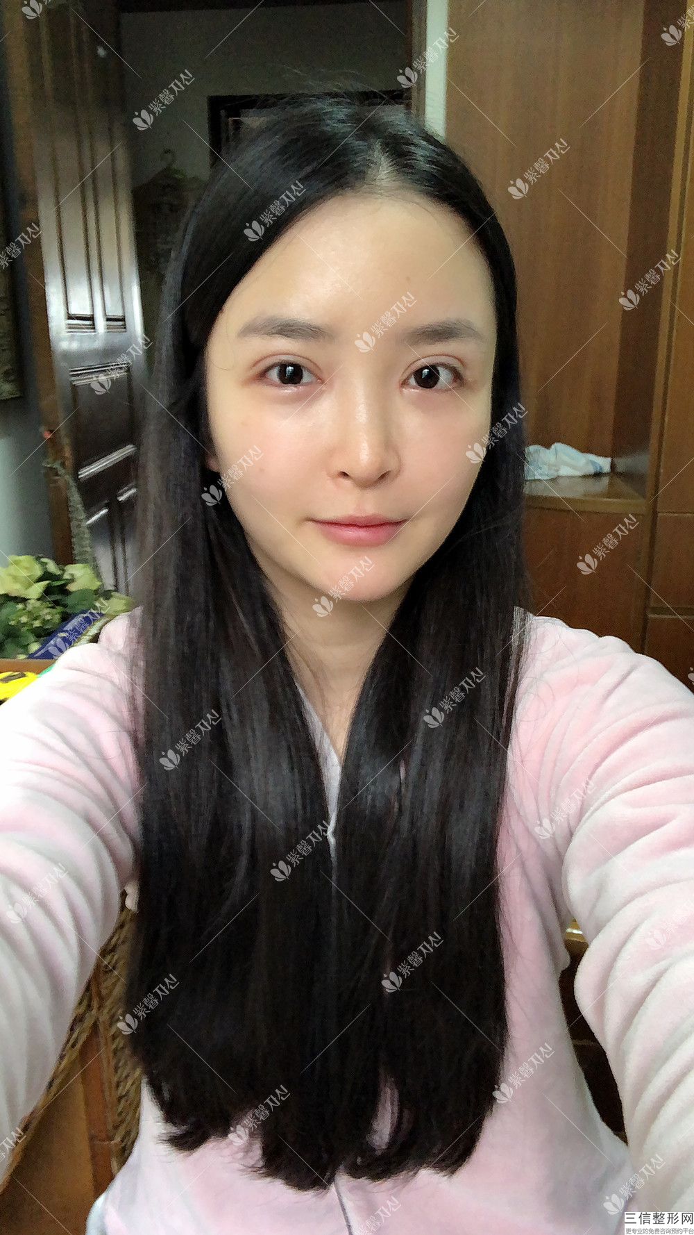 激光可以修复双眼皮吗(激光祛疤可以修复双眼皮疤痕吗)