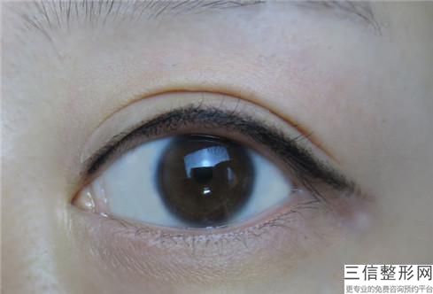 什么叫做无痕双眼皮，是长久的吗