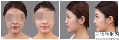 手术注意事项及适应人群介绍比较为常见的选材及操作流程，让各位快速获得立体完好的鼻子