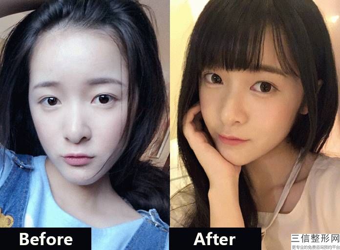 打瘦脸针瘦脸多少钱瘦脸的过程不仅麻烦而且艰难