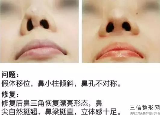 硅胶隆鼻术前注意事项又有什么呢？而硅胶