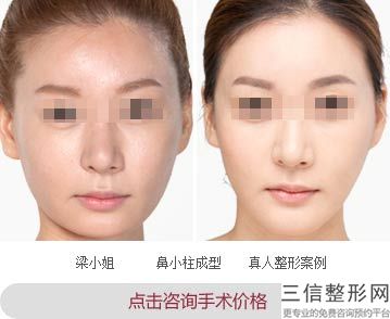 硅胶隆鼻要多少钱隆鼻设备需要的费用和选择