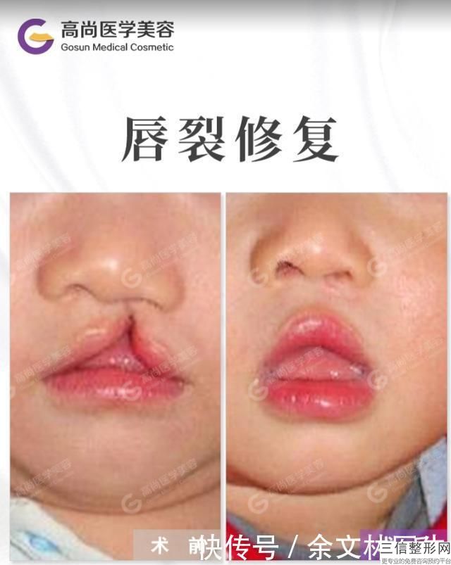 脱唇毛费用跟脱毛方法有关吗?方法