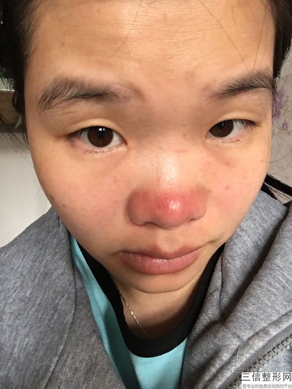 肋软骨隆鼻的价格和求美者自身的情况分析