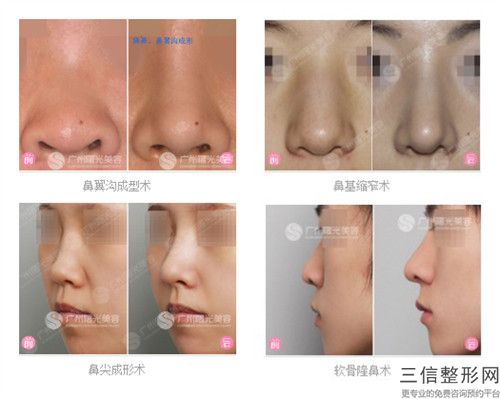 做硅胶隆鼻多少钱？做隆鼻注意事项有哪些？