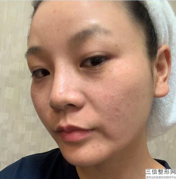 铒激光负荷有效的治疗私密部位会有什么后遗症