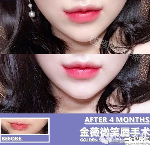 厚嘴唇变薄会留下疤痕吗？专家全面分析