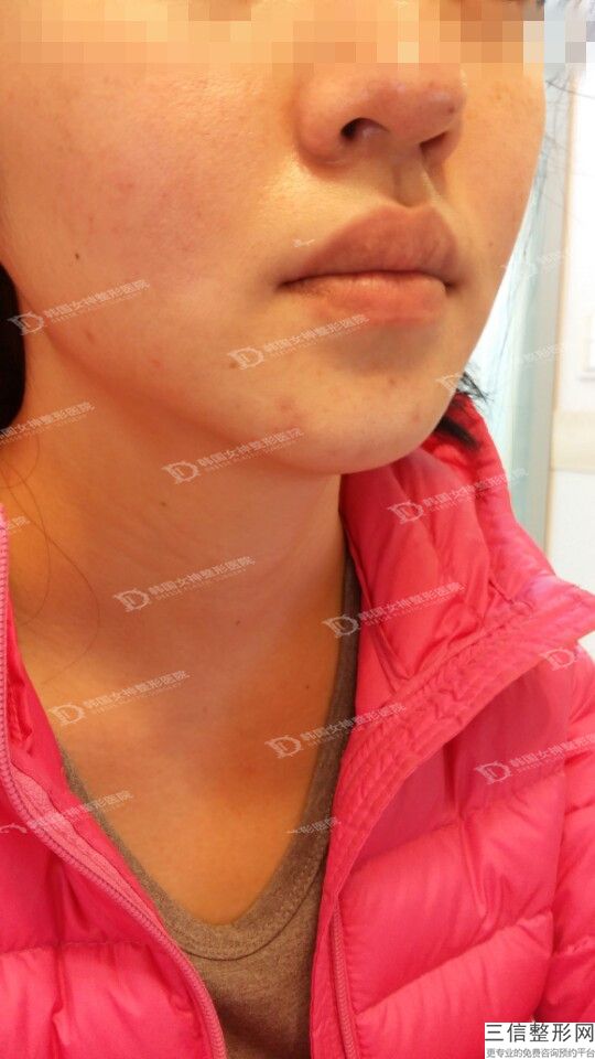 唇毛激光脱毛有哪些方法和优点？膏效果不好