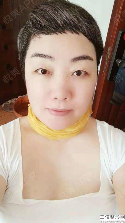 做发际线脱毛哪个更安全？脱发怎么办？