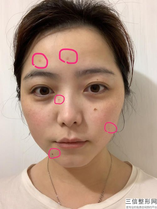 用郑州洪光治疗痘痘的费用是多少？(图)