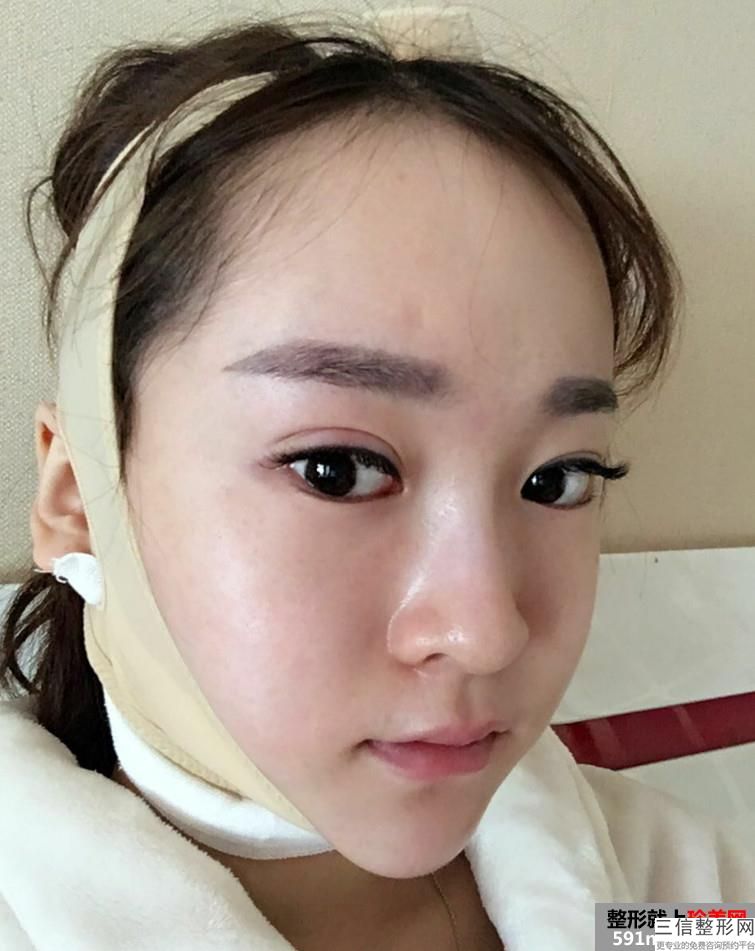 做唇部激光手术安全吗？激光去除胎记的方法