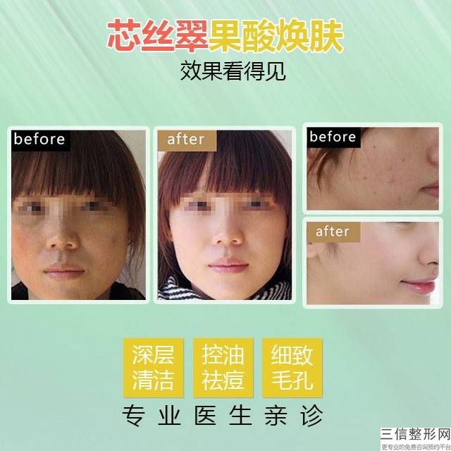 南京打肉毒杆菌注射除皱多少钱？(图)！