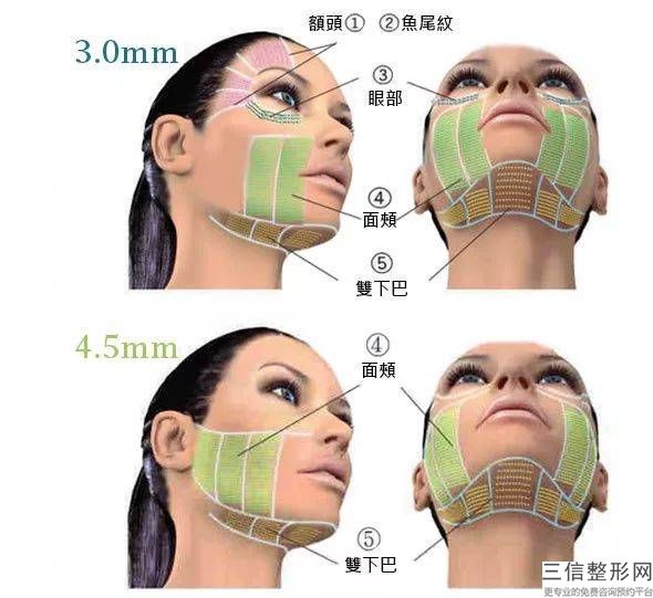 生物瘦脸多少钱,瘦脸一般多少钱？