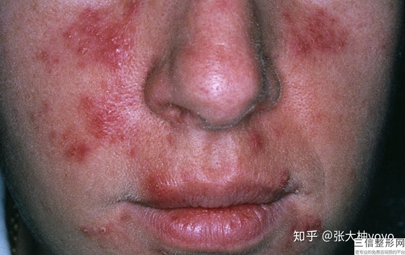 收缩鼻翼多少钱,收缩鼻翼要多少钱