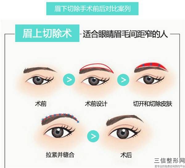 开内眼角一直流泪需要及时去医院吗