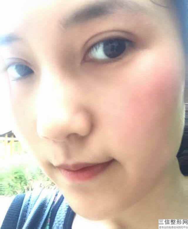 面部做丰额头常见后遗症有？血肿是什么引起