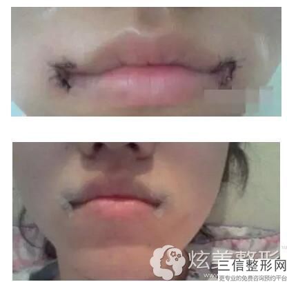 兔唇治疗手术一次要花费好多钱，唇腭裂得做几回微创手术