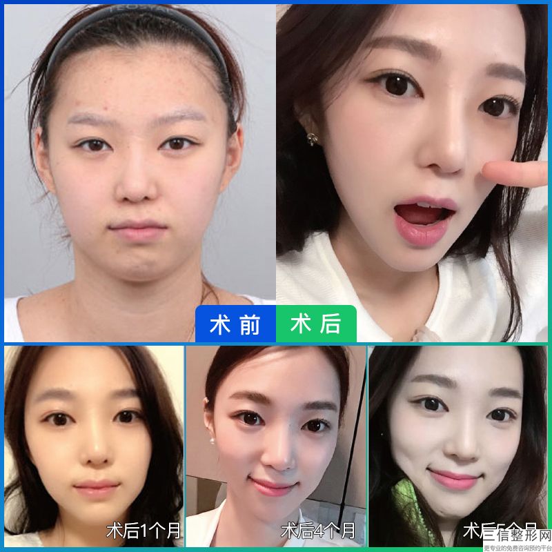 自体脂肪脸部填充多少费用
