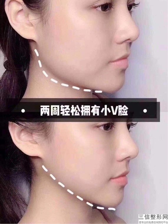 自体脂肪填充脸部多少钱