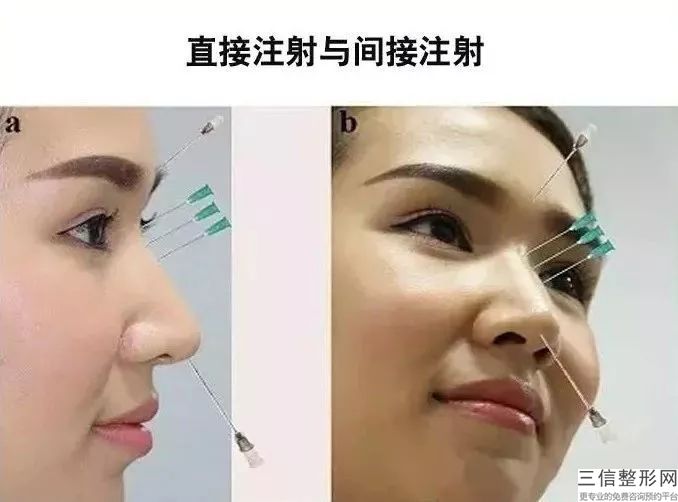 鼻孔里长痘(鼻孔里长痘痘是什么原因)