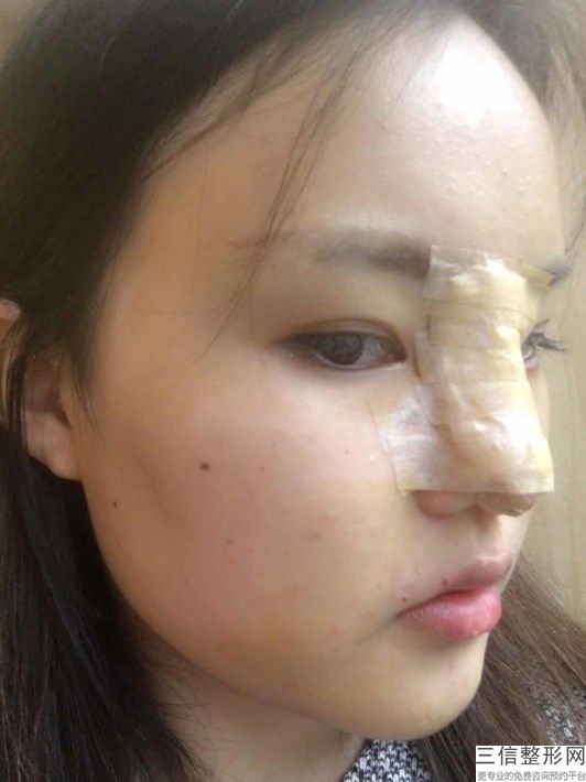 鼻中隔软骨隆鼻(鼻中隔软骨隆鼻效果)