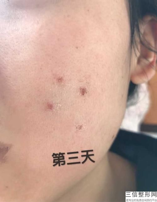 连云港「重要分享」激光祛斑几天恢复正常,—记者爆料，真相揭秘