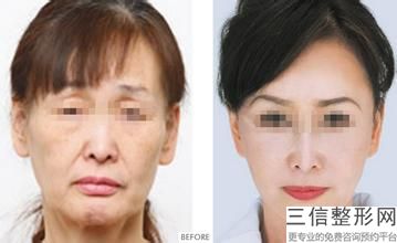保妥适瘦脸针打完多久有效果，保妥适打瘦脸针好不好