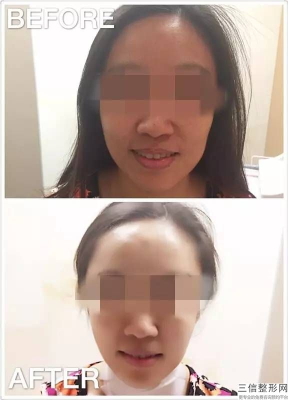 保妥适瘦脸针打完多久有效果，保妥适打瘦脸针好不好