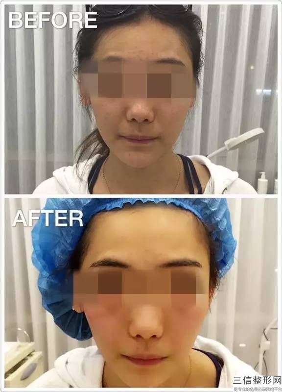 保妥适瘦脸针价位，保妥适瘦脸针一次多少钱