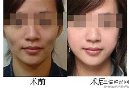 洛阳市电波溶脂瘦脸医生排行榜名单请签收-任天平主治医师医生口碑技术好吗