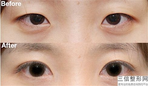 黄晓辉整形医生3点韩式双眼皮名单看到就是赚到-江西省人民医院激光整形美容科
