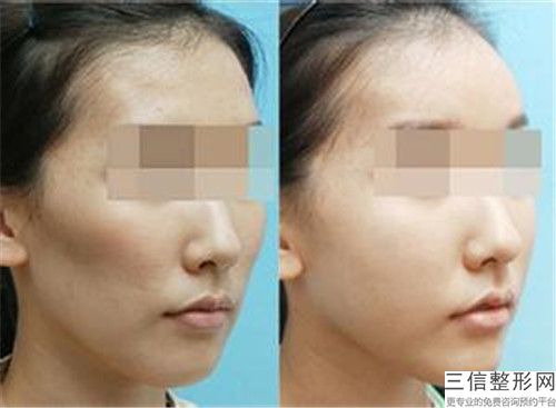 上海市面部皮肤整形价格表(费用)各个项目上线-上海市面部皮肤整形手术得要多少钱