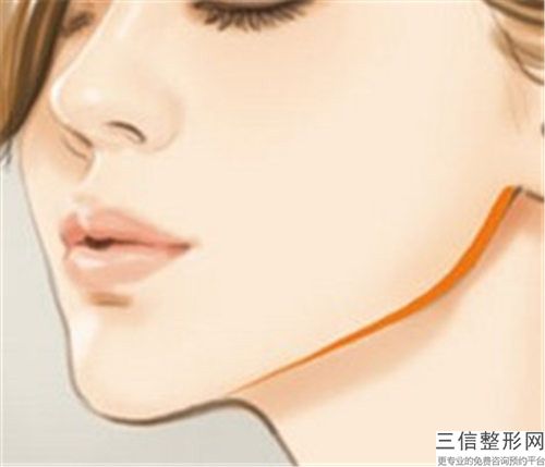 金恩洙丰下巴手术手术方法哪个效果好
