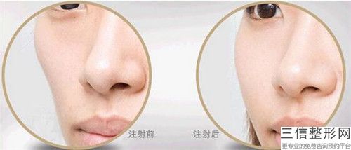 洪政槿（韩国）脸部下垂面部提升术术能保持到什么时候