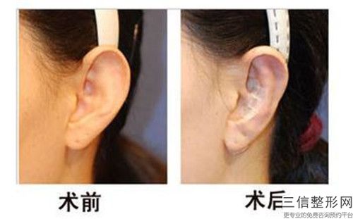 通化双耳再造术的6大美容功效