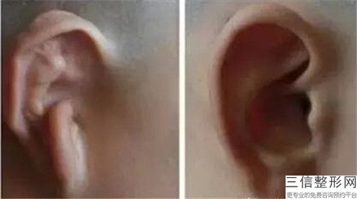 聊城耳朵贴脑矫正会对以后生宝宝有影响吗