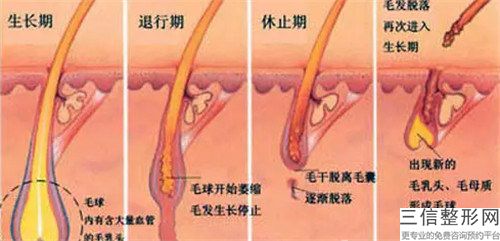 胡子脱毛手术手术怎么做才比较安全