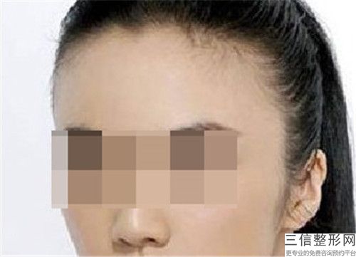 江油茗汇医疗美容诊所太阳穴后的风险并发症有哪些