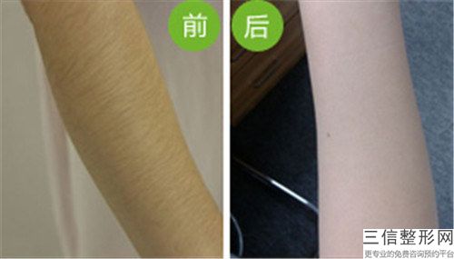 唇部激光脱毛术会有什么副作用