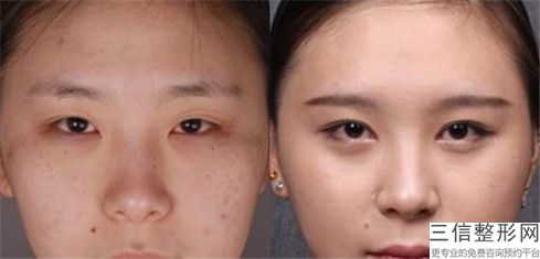 飞秒近视眼手术方法更为安全_飞秒近视眼手术的安全性怎么样