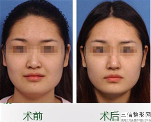 耳软骨隆鼻隆鼻整形都有哪些风险