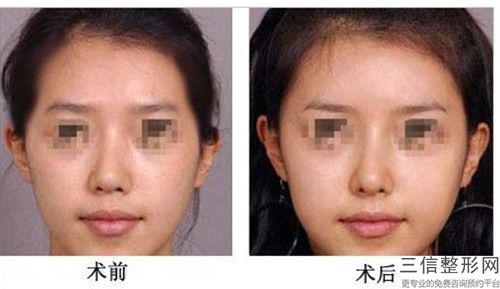 延安太阳穴手术后有什么后遗症