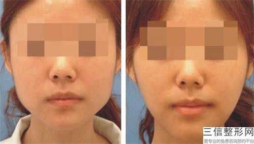 下颌正位智齿拔除(非倒伏、弯根、埋伏齿)的整形手术有哪些副作用