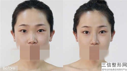 姜宁医生牙齿矫正整颌案例-收费标准信息公示