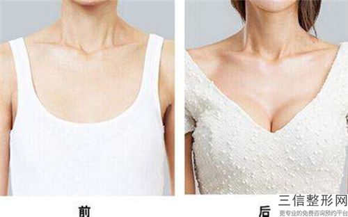 石荣艾整形医生副乳去除水平怎么样项目分享技术评价实力揭晓