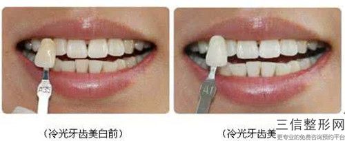 黔东南牙齿无创美学修复手术是不是很安全有没有风险
