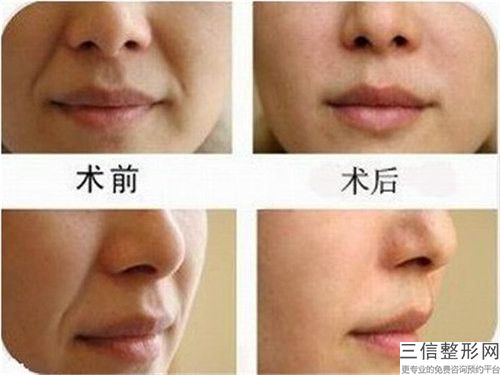 苏州美夏林医疗美容E光除皱抗衰的材料安全吗