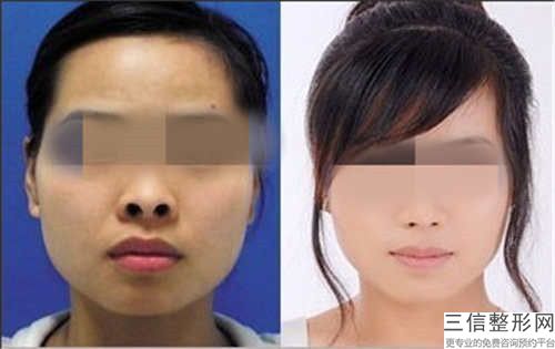 李衍江唇毛重用脱毛效果多可保持多久