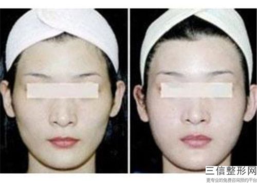 江苏省毛文书整形医生脸上雀斑消除祛斑手术价格便宜吗