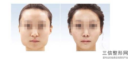 郴州冠华口腔医院上颌阻生智齿拔除（完全萌出）手术安全性要如何保障